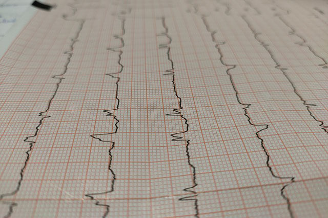 Arrhythmias: Causes, Diagnosis, Treatment, and Management